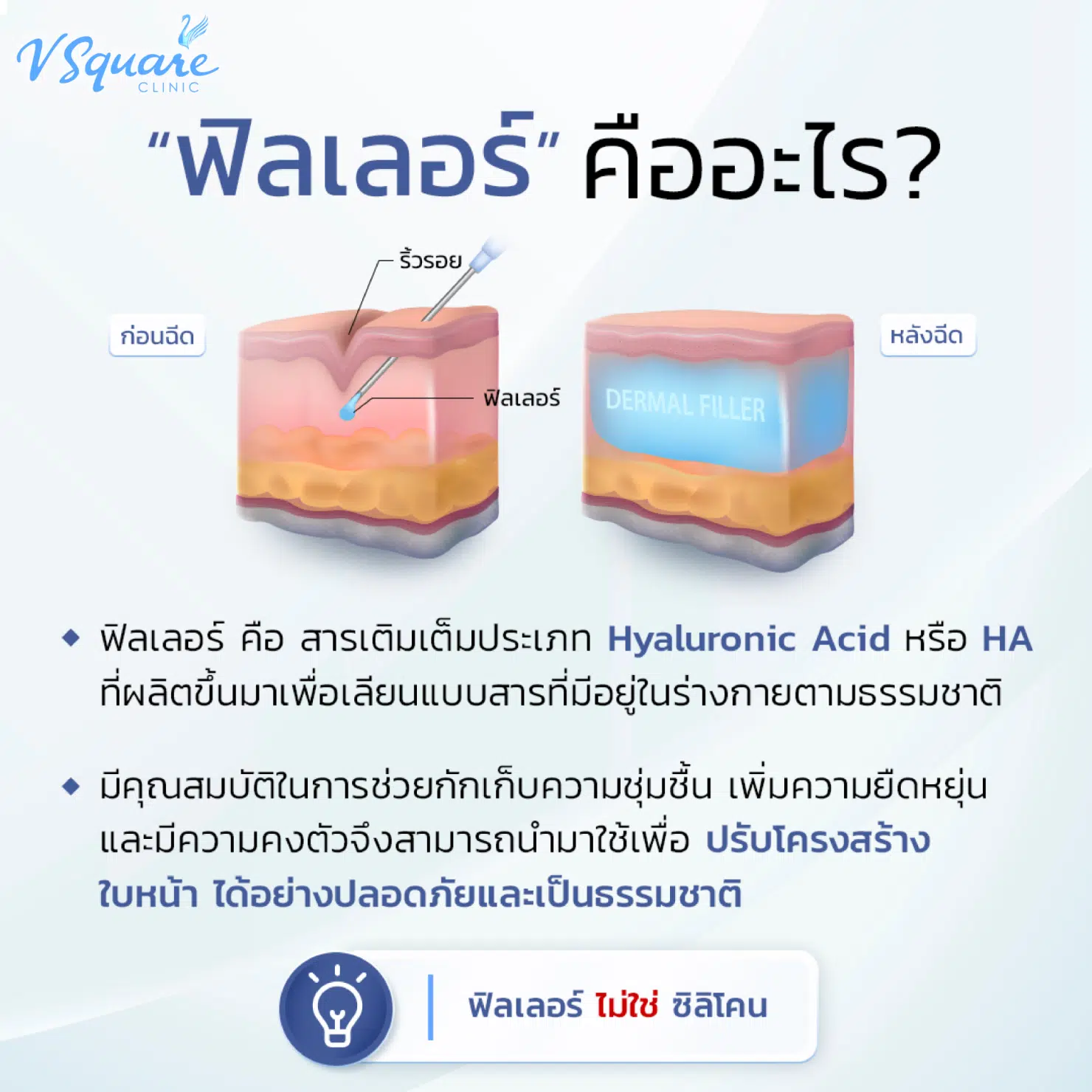ฉีดฟิลเลอร์ คืออะไร