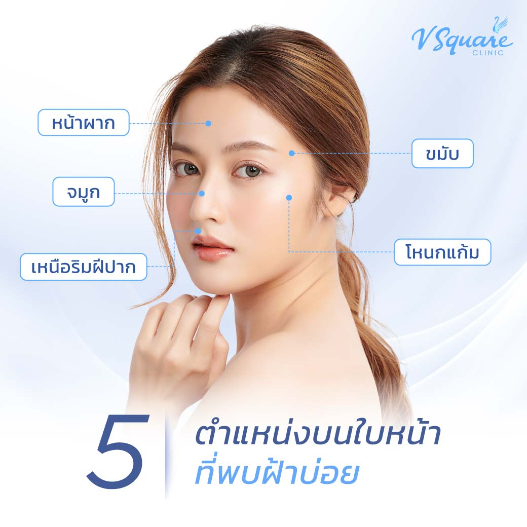 ตำแหน่งฝ้าที่พบบ่อยบนใบหน้า