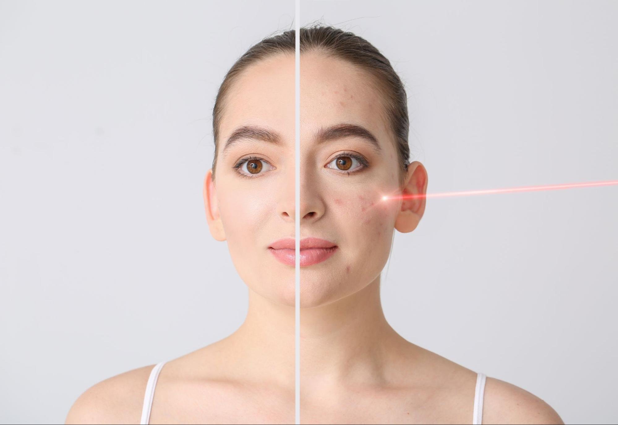 ทำเลเซอร์หลุมสิว