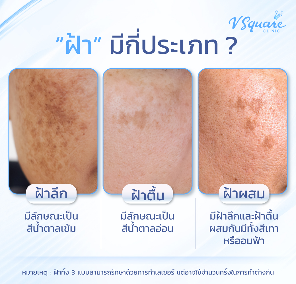 ฝ้าบนใบหน้ามีกี่ประเภท
