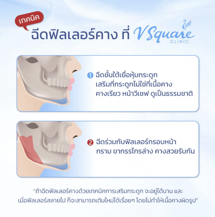 ฉีดฟิลเลอร์คางที่ V Square Clinic