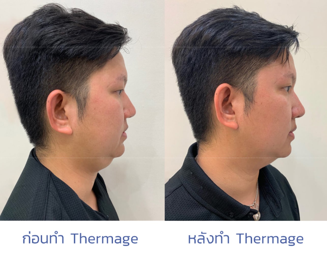 รีวิวหลังทำ Thermage ใบหน้า 