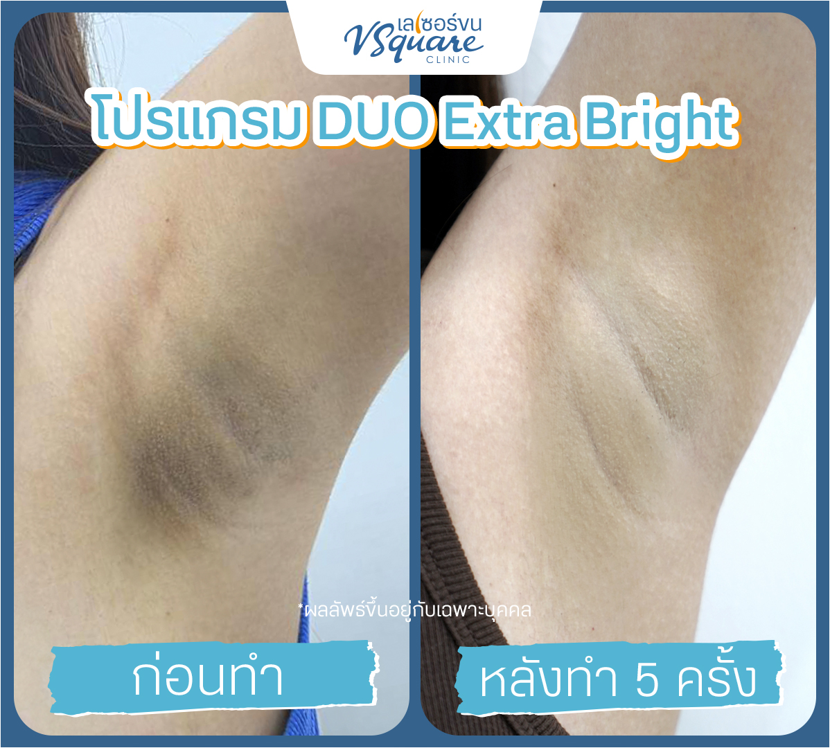 รีวิวเลเซอร์รักแร้ขาว Yag Reju Duo Extra Bright