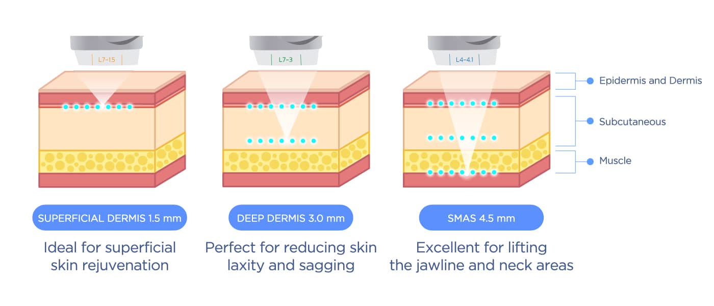 หลักการทำงาน Ulthera