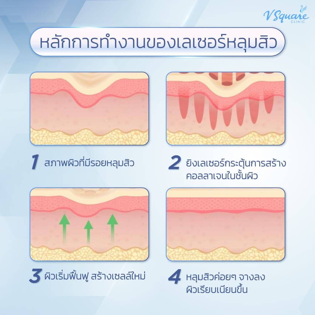 หลักการทำงานของเลเซอร์หลุมสิว