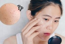 เลเซอร์กระเนื้อ