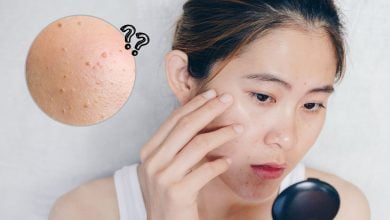 เลเซอร์กระเนื้อ