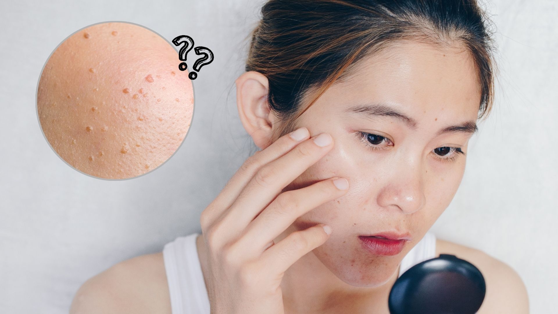 เลเซอร์กระเนื้อ