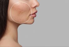 เลเซอร์หลุมสิว