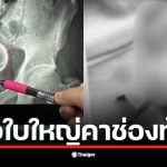 ชายหนุ่มไต้หวันเข้ารับการผ่าตัดด่วนหลังมีแก้วเซรามิกติดในช่องท้อง