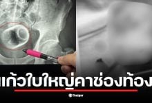 ชายหนุ่มไต้หวันเข้ารับการผ่าตัดด่วนหลังมีแก้วเซรามิกติดในช่องท้อง