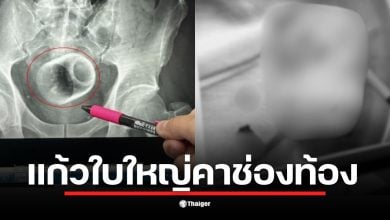 ชายหนุ่มไต้หวันเข้ารับการผ่าตัดด่วนหลังมีแก้วเซรามิกติดในช่องท้อง