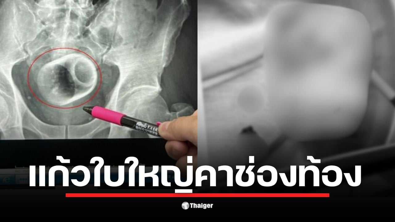 ชายหนุ่มไต้หวันเข้ารับการผ่าตัดด่วนหลังมีแก้วเซรามิกติดในช่องท้อง