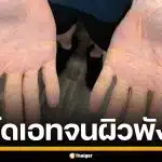 อุทาหรณ์! หนุ่มมะกัน ลดน้ำหนัดสุดโต่ง กินเนื้อ-ไขมันวันละ 4 กิโล จนสภาพผิวพัง