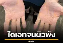 อุทาหรณ์! หนุ่มมะกัน ลดน้ำหนัดสุดโต่ง กินเนื้อ-ไขมันวันละ 4 กิโล จนสภาพผิวพัง