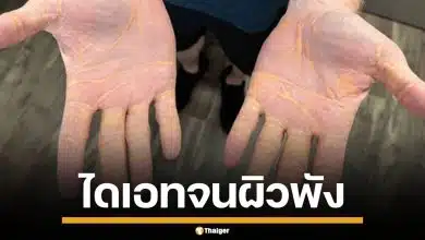 อุทาหรณ์! หนุ่มมะกัน ลดน้ำหนัดสุดโต่ง กินเนื้อ-ไขมันวันละ 4 กิโล จนสภาพผิวพัง