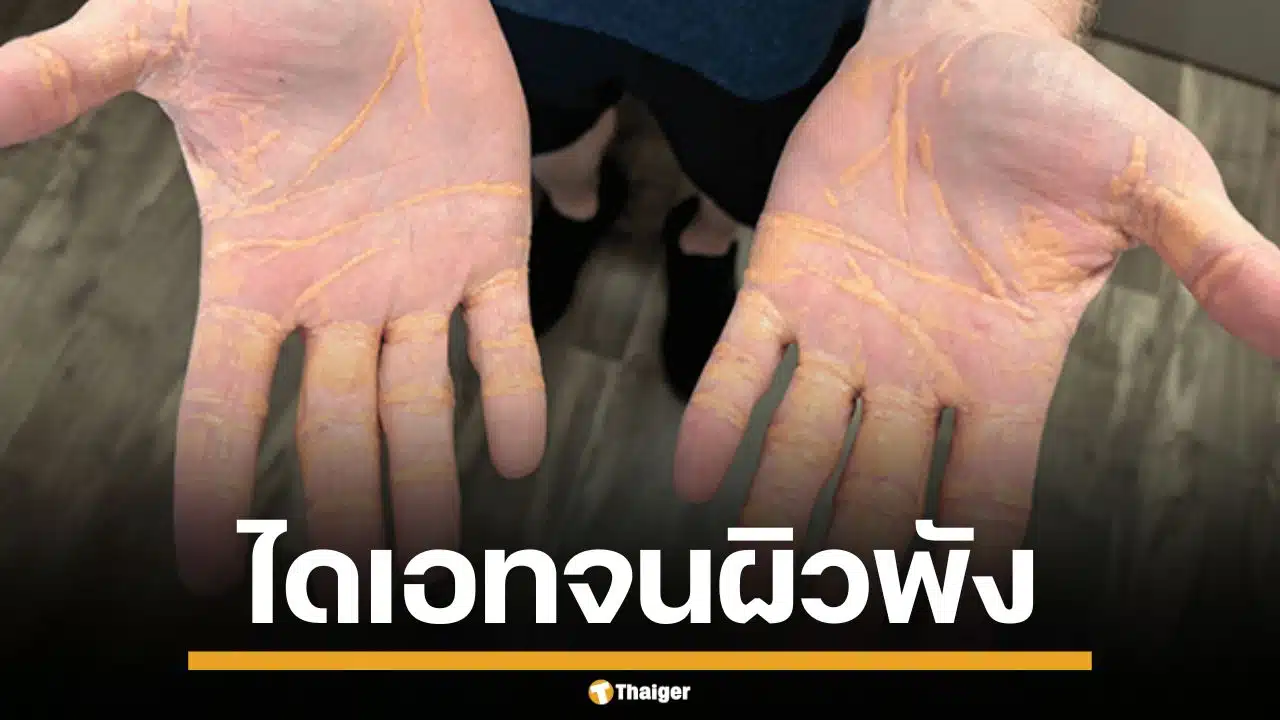 อุทาหรณ์! หนุ่มมะกัน ลดน้ำหนัดสุดโต่ง กินเนื้อ-ไขมันวันละ 4 กิโล จนสภาพผิวพัง