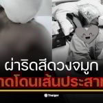 สาวโพสต์อุทาหรณ์ แฟนผ่าตัดวันแรกตาบวมเลือดคั่ง หมอเพิ่งแจ้งวันที่ 2 ว่าเสี่ยงบอด สุดท้าย รพ.ที่ 3 ยัน &quot;เส้นประสาทโดนตัด&quot;