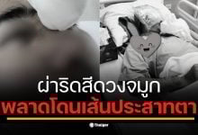 สาวโพสต์อุทาหรณ์ แฟนผ่าตัดวันแรกตาบวมเลือดคั่ง หมอเพิ่งแจ้งวันที่ 2 ว่าเสี่ยงบอด สุดท้าย รพ.ที่ 3 ยัน &quot;เส้นประสาทโดนตัด&quot;