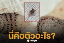 ขนลุก! หมอผ่าเจอ ตัวอ่อนแมลงวันบอทฟลาย ซุกใต้ผิวหนังคนไข้กลับจากบราซิล โซเชียลผวาหวั่นปรสิตระบาดในไทย