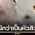 สยอง! หนุ่มไทย แชร์อุทาหรณ์ &quot;แมลงวันมะม่วง&quot; ไชผิวหนัง ฝังตัวอ่อนจนต้องผ่าออก