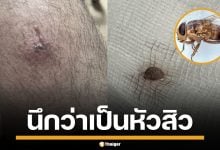 สยอง! หนุ่มไทย แชร์อุทาหรณ์ &quot;แมลงวันมะม่วง&quot; ไชผิวหนัง ฝังตัวอ่อนจนต้องผ่าออก