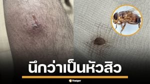 สยอง! หนุ่มไทย แชร์อุทาหรณ์ &quot;แมลงวันมะม่วง&quot; ไชผิวหนัง ฝังตัวอ่อนจนต้องผ่าออก