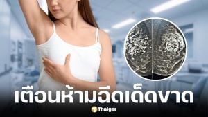แพทยศาสตร์ศิริราช เตือนห้ามฉีดสารกระตุ้นคอลลาเจนที่เต้านม เสี่ยงเกิดก้อนแข็งอักเสบเรื้อรัง