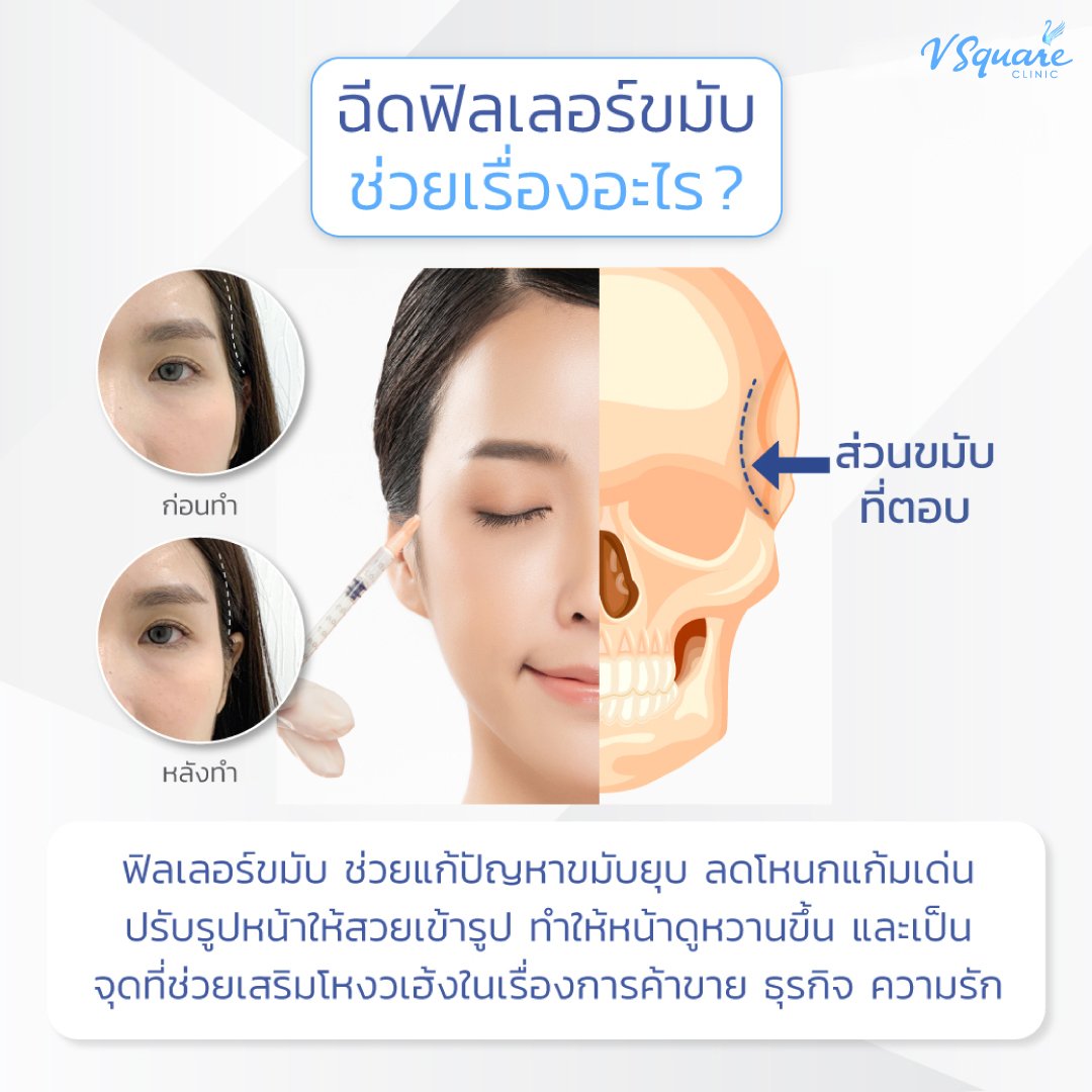 ฉีดฟิลเลอร์ขมับ ช่วยอะไร