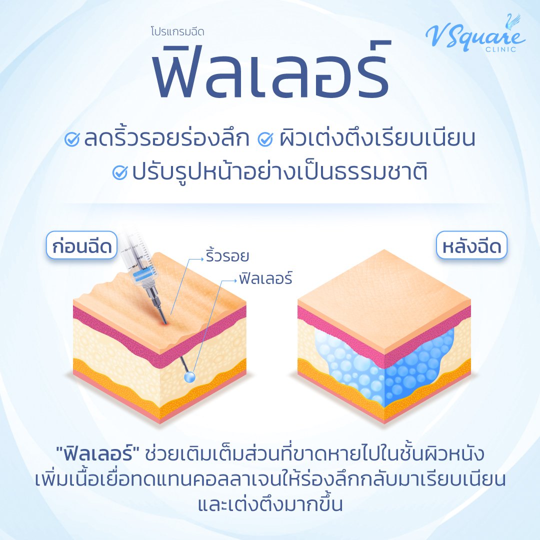 ฟิลเลอร์ คืออะไร