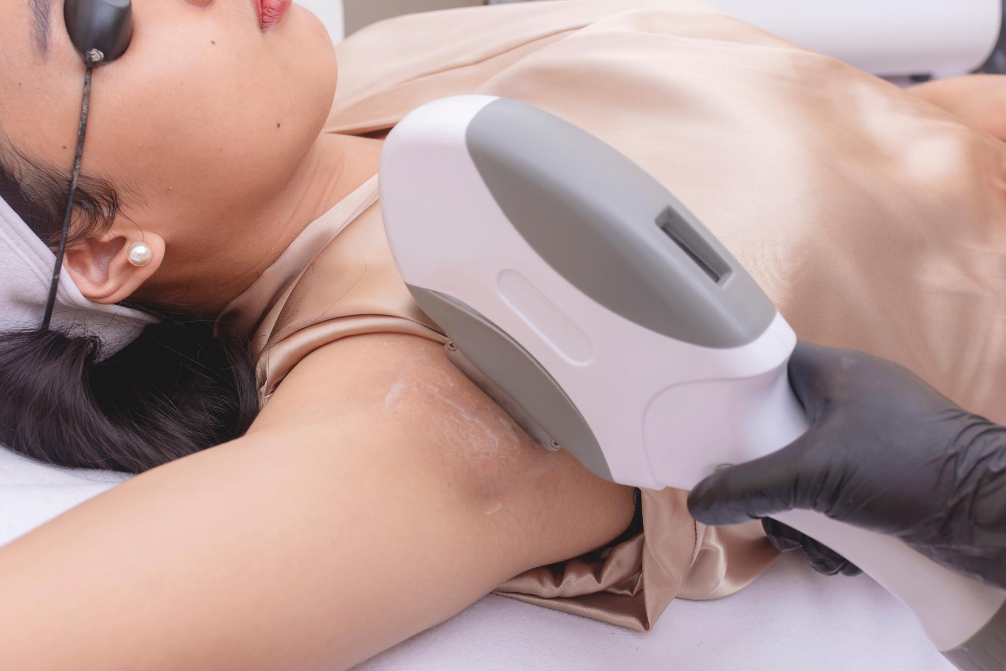 IPL กำจัดขน