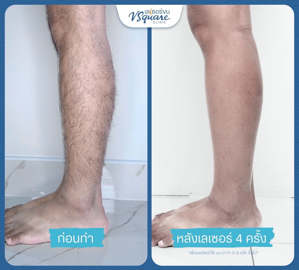 รีวิวเลเซอร์กำจัดขนขา