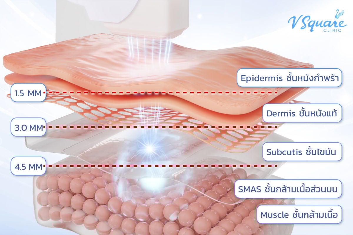 Ulthera ยิงพลังงานลึกถึง SMAS