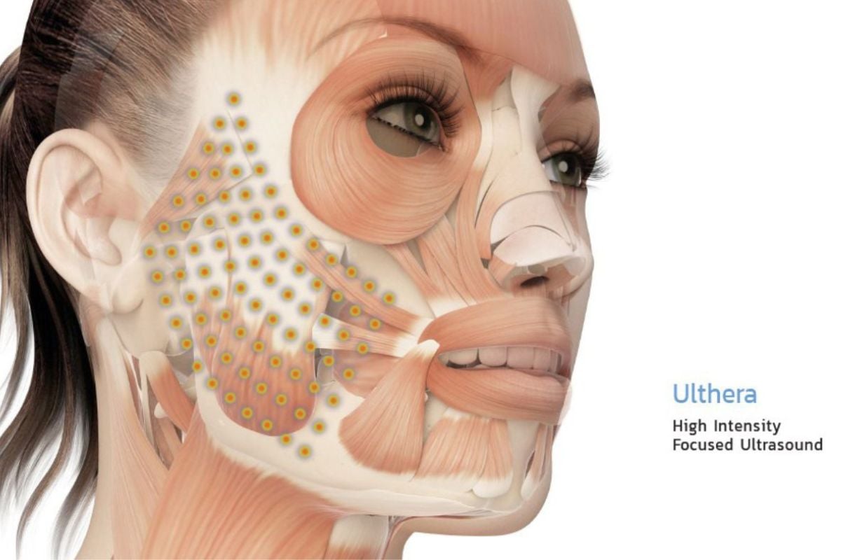 หลักการทำงาน Ulthera