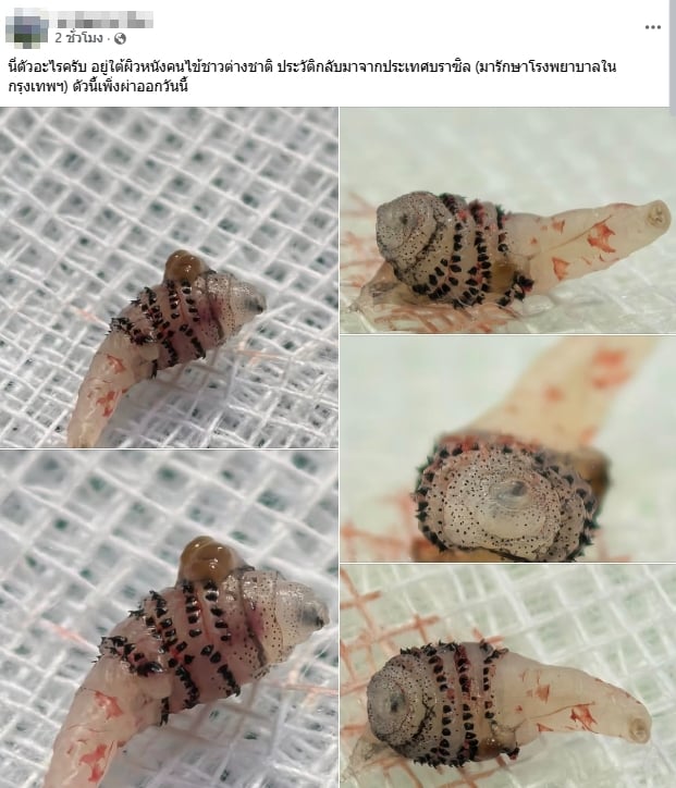 ขนลุก! หมอผ่า หนอนบอทฟลาย ซุกใต้ผิวหนังคนไข้กลับจากบราซิล โซเชียลผวาหวั่นระบาดในไทย-1