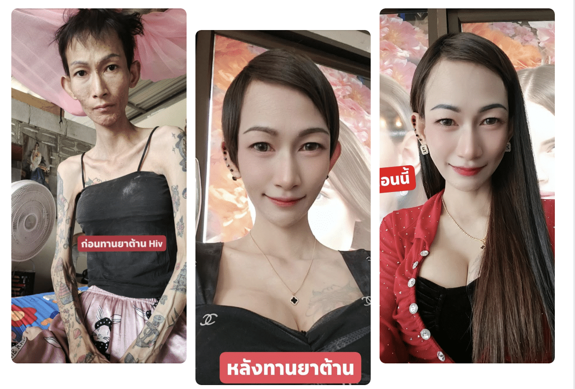 กราบหัวใจ สาวป่วยภาวะเอดส์ CD4 เหลือ 6 ผอมหนังติดกระดูด ฮึดสู้ 3 เดือนกลับมาแข็งเหมือนคนปกติ