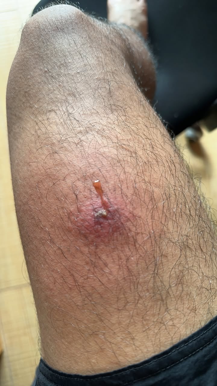 ตุ่มแดงที่มีลักษณะคล้ายฝีหรือสิวอักเสบ