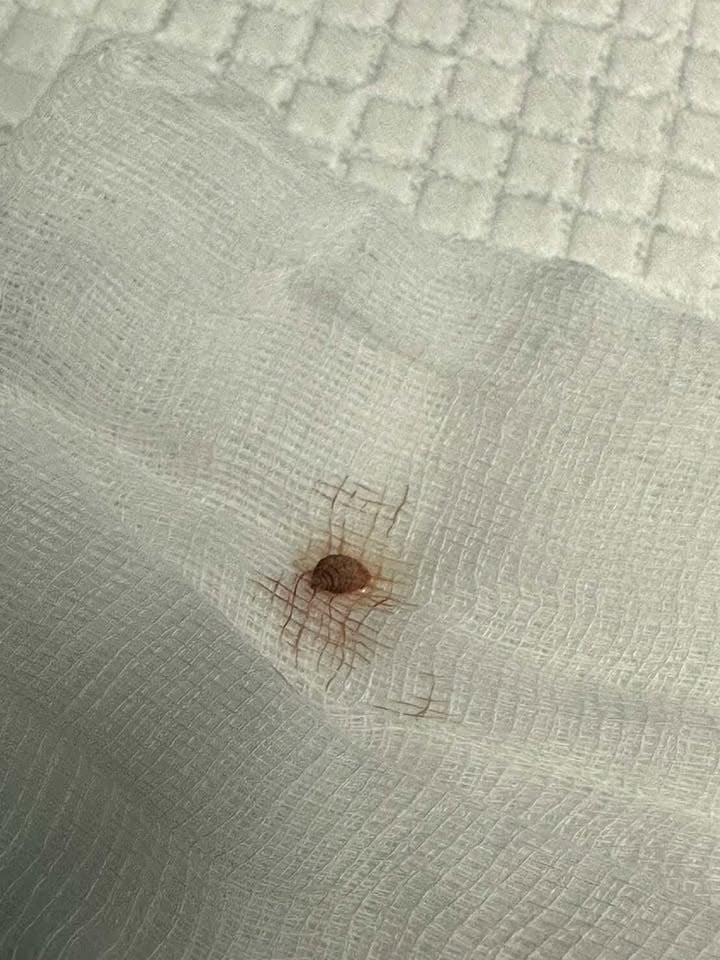 ตัวอ่อนแมลงวัน (Larva) ที่ถูกคีบออกมา