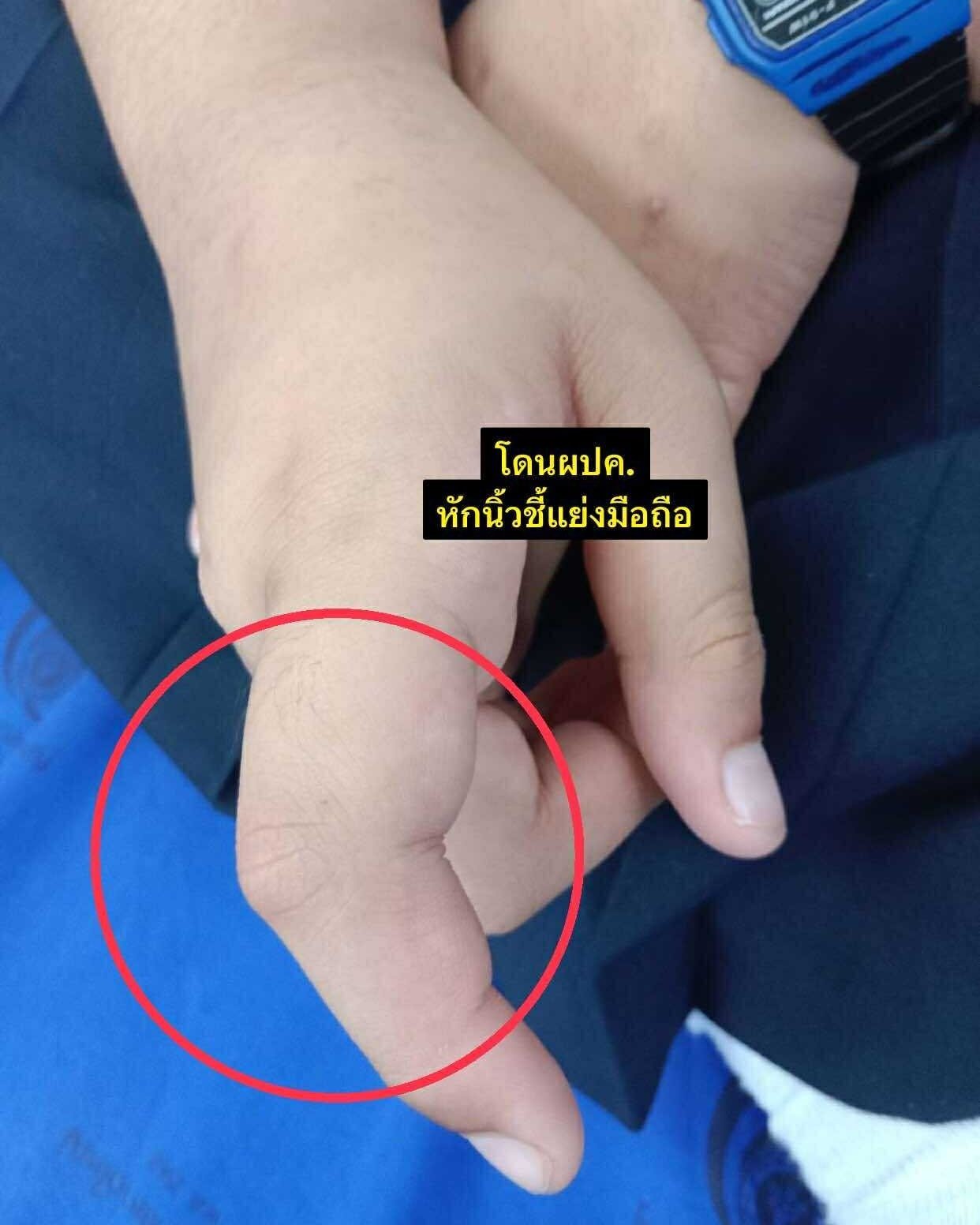 เด็กที่ถูกผู้ปกครองของเพื่อนหักนิ้ว