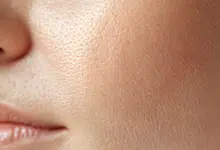 รูขุมขว้างกว้างเกิดจากอะไร