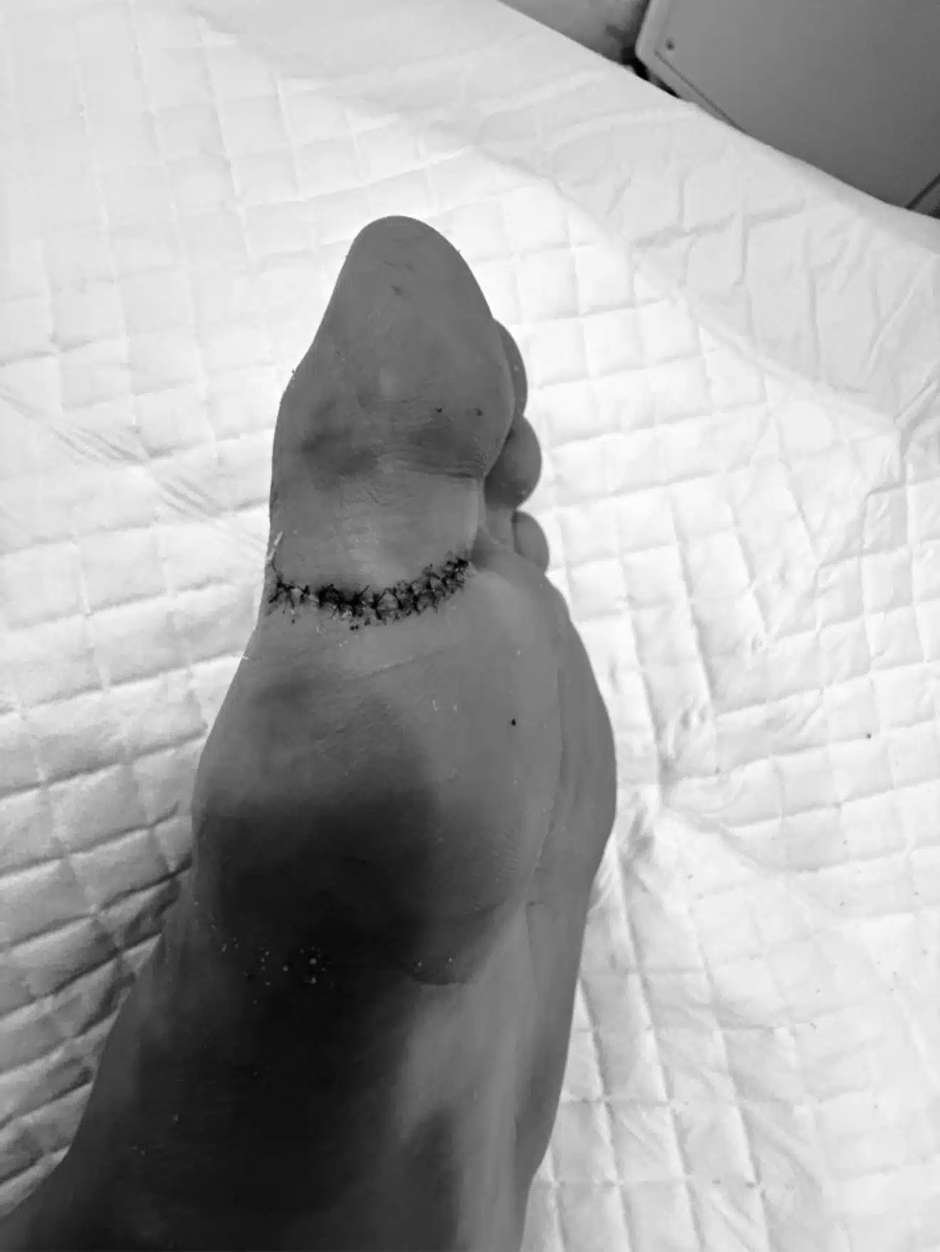 น้องเบส แข่งขันวอลเลย์บอลชายหาดหญิงไทย แม้ต้องเย็บ 14 เข็ม