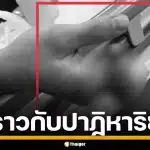 หนุ่มเวียดนาม ถูกเครื่องจักรบดนิ้วเละ 4 นิ้ว ทีมแพทย์ผ่าตัด 12 ชม. กู้มือคืนสำเร็จ