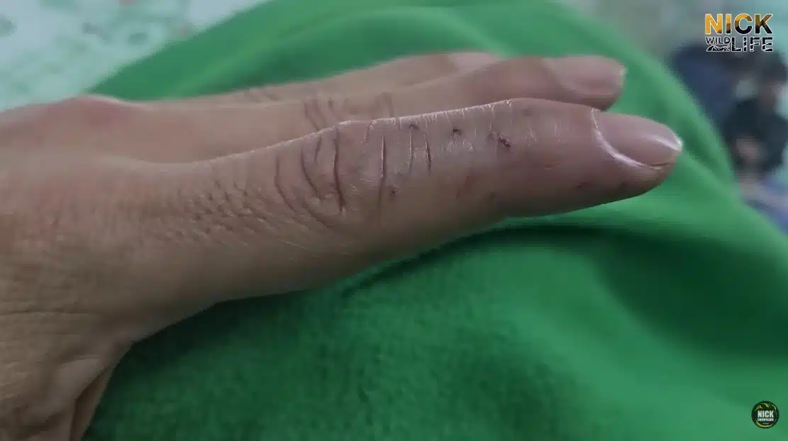 นิค Wildlife ถูกงูจงอางกัด-5