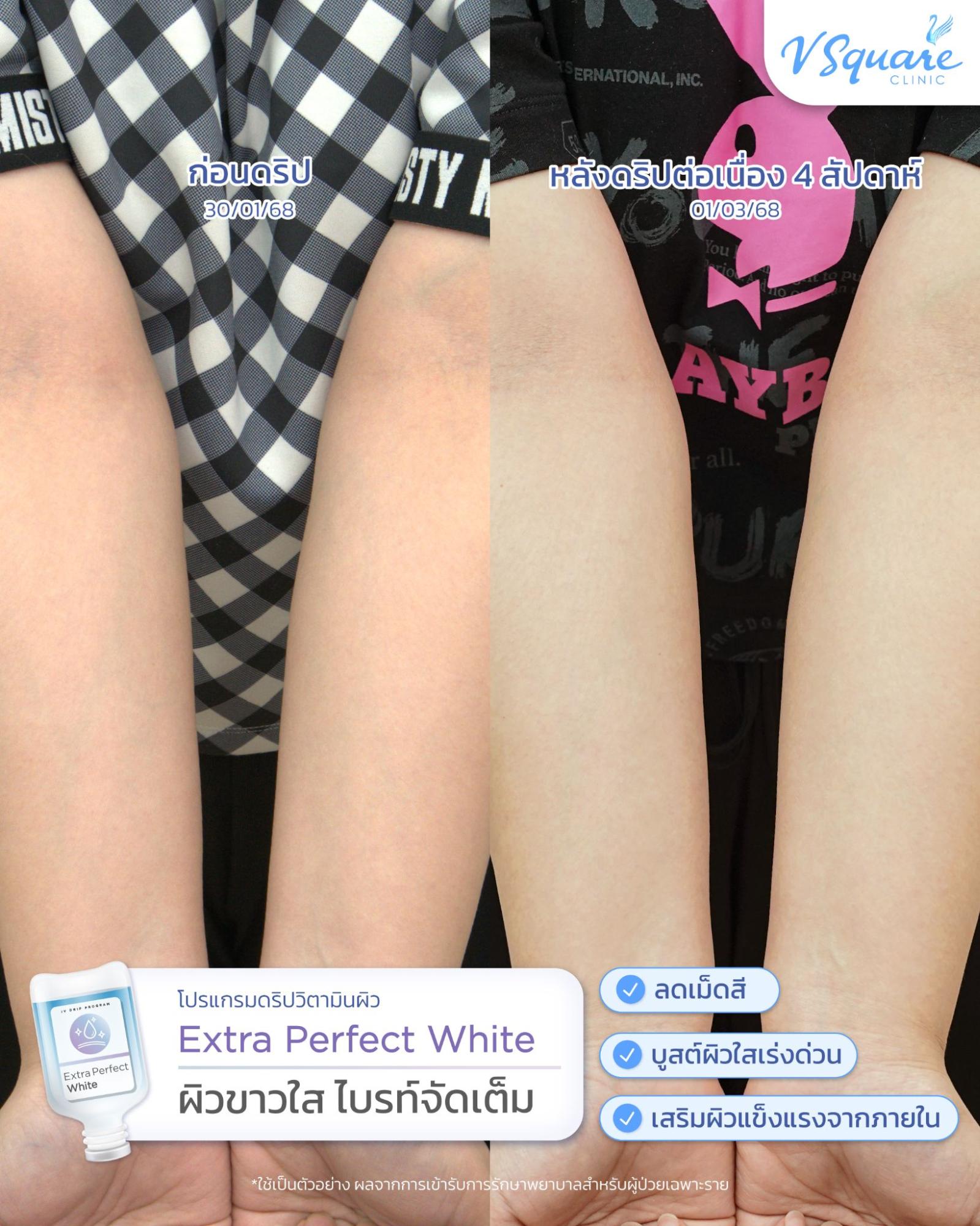 รีวิวฉีดวิตามินผิว