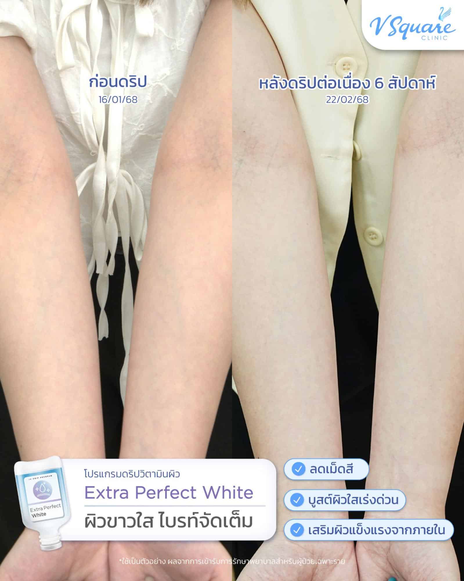 รีวิวฉีดวิตามินผิว