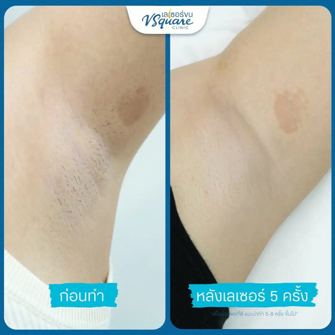 เลเซอร์รักแร้รีวิว