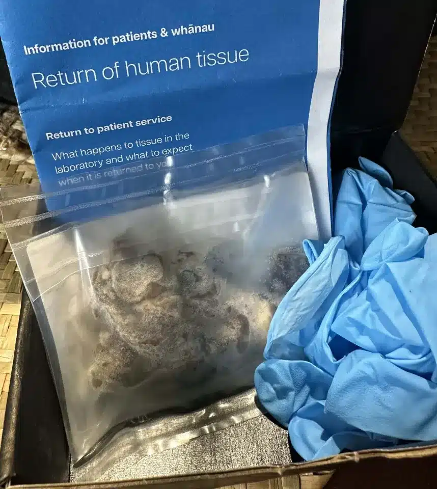 วัยรุ่นชายวัย 17 ปีโชคร้ายต้องผ่าตัดปอดเพราะผลกระทบจากบุหรี่ไฟฟ้า