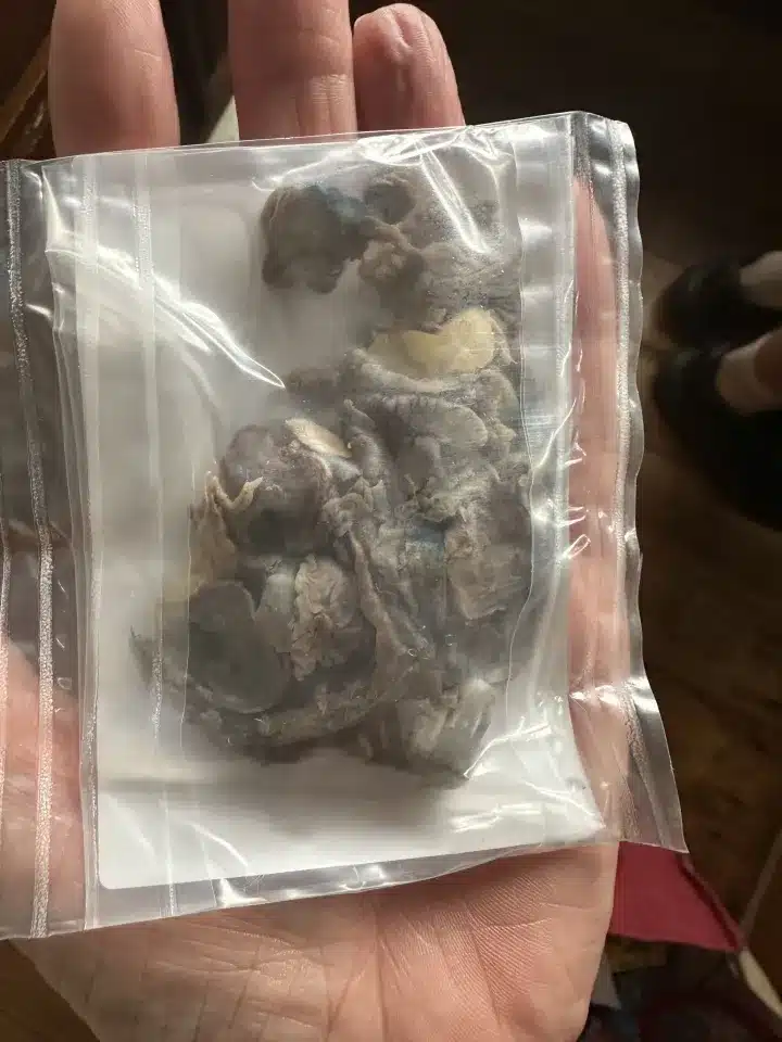 ลีเรย์ คิง วัยรุ่นที่ต้องเผชิญกับปัญหาปอดดำจากการใช้บุหรี่ไฟฟ้า