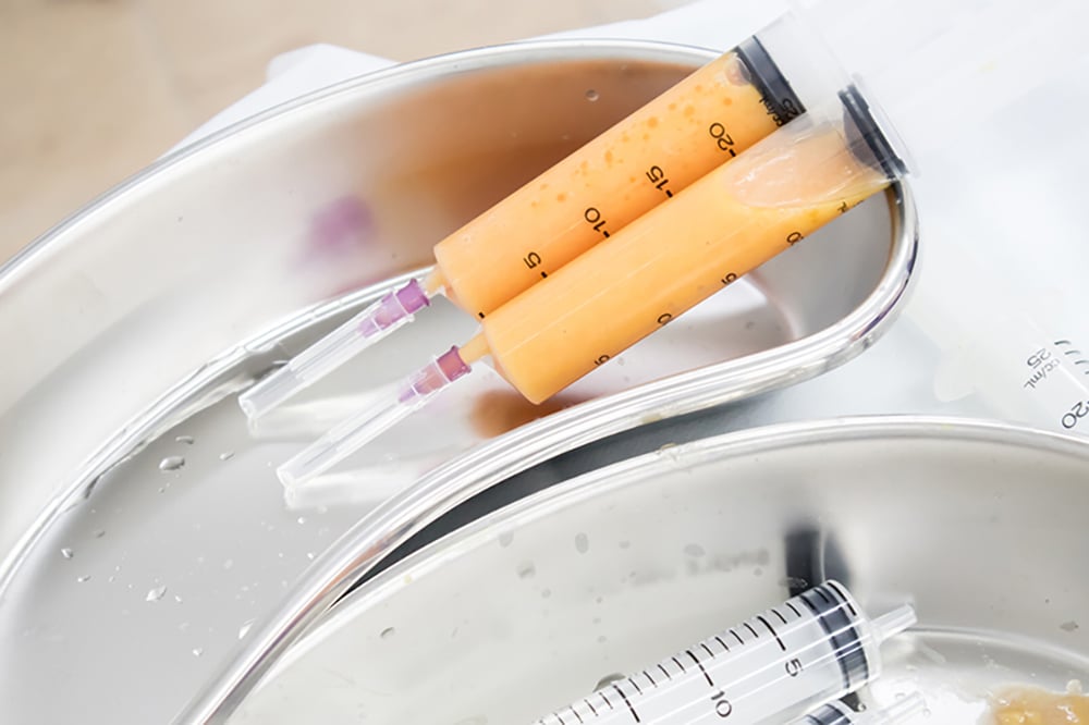 การเติมไขมันใต้ตา