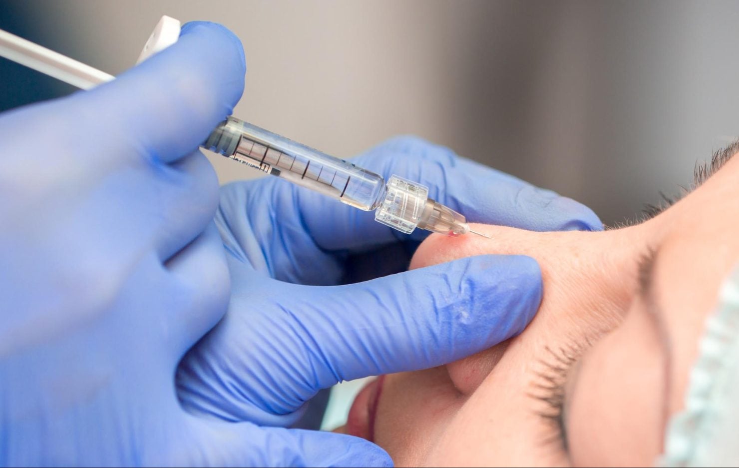 ฉีดฟิลเลอร์จมูก คืออะไร